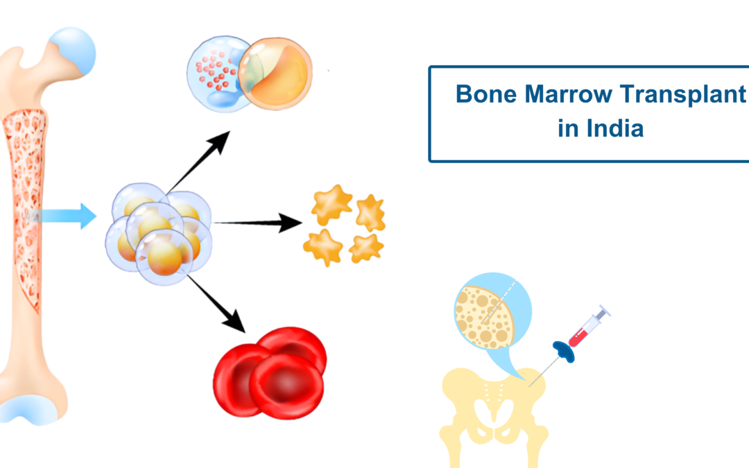 Bone Marrow Transplant in India